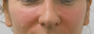 Cheeks-after-300×110