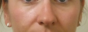 Cheeks-before-300×110