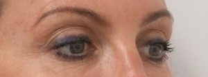 Eyebrow-lift_1-after-300×112