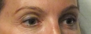 Eyebrow-lift_1-before-300×112