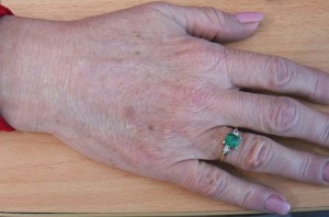 Hands_after-300×198