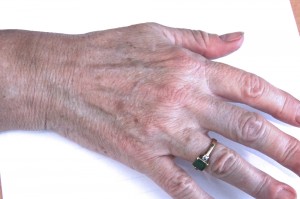 Hands_before-300×199