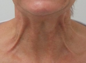 Neckbands_before-300×222