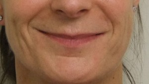 Smile-after-3-300×170