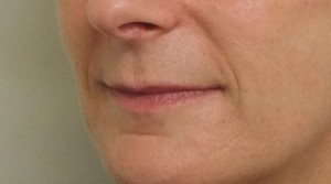 Smile-after1-300×167