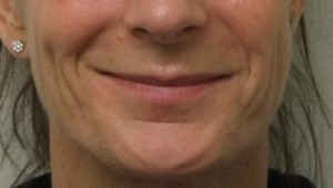 Smile-before-3-300×170