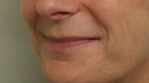 Smile-before1-300×167